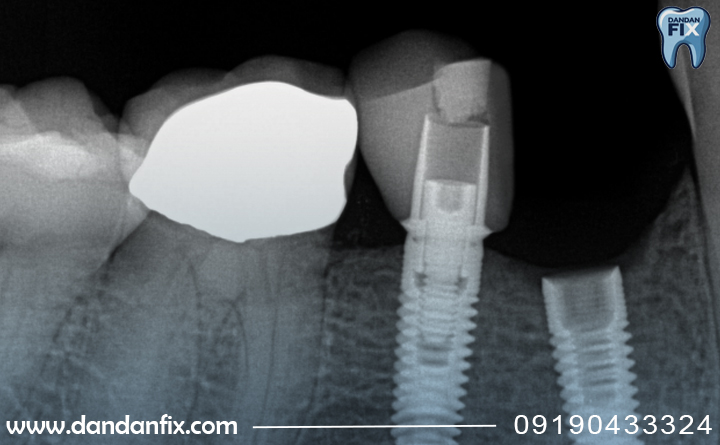 تحلیل استخوان ولق شدن ایمپلنت