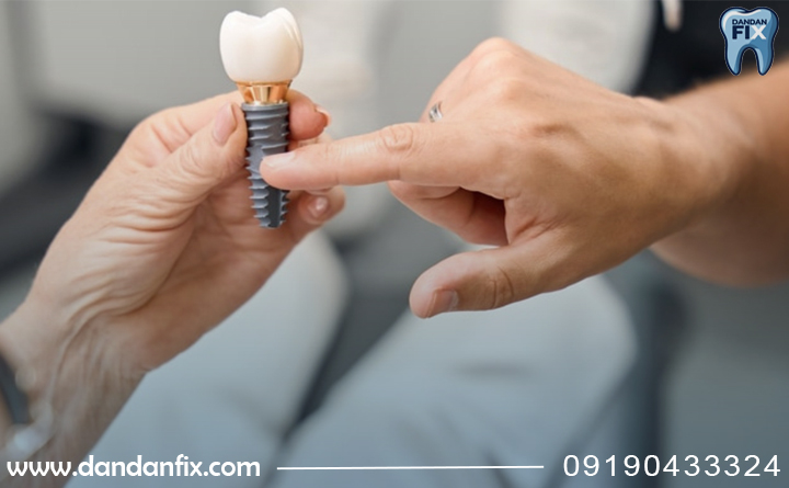 طول عمر ایمپلنت