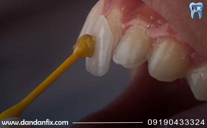 لمینت دندان