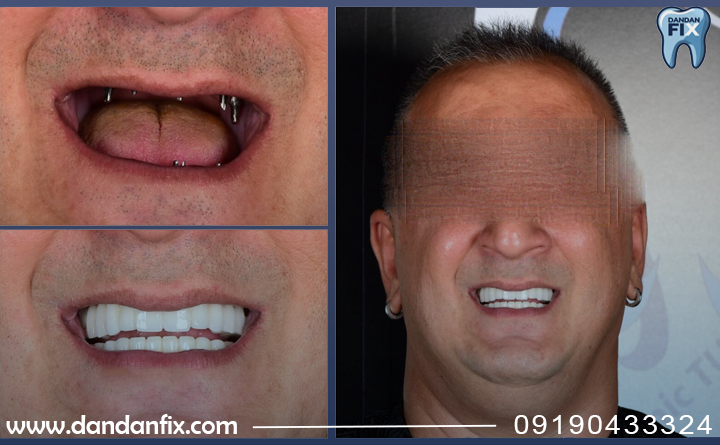 ایمپلنت کامل فک