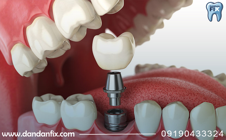 تجربه بیماران از ایمپلنت