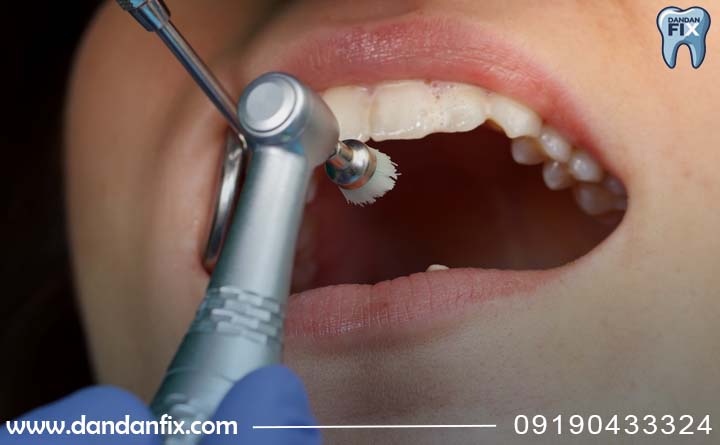 بروساژ دندان