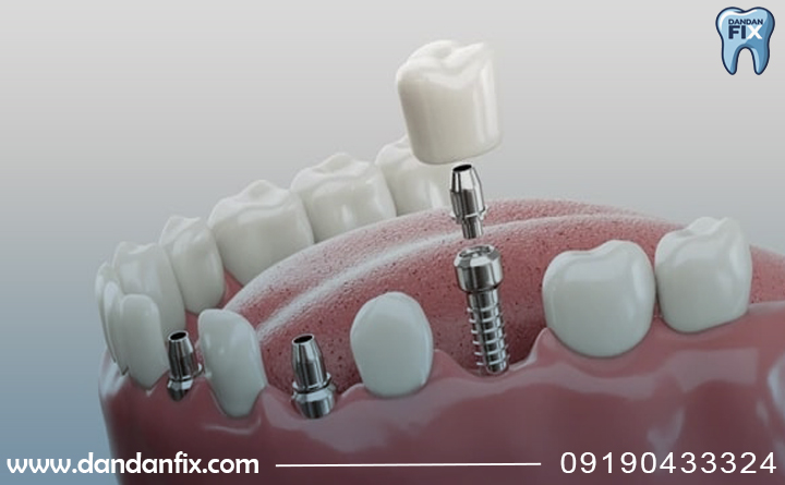 ایا ایمپلنت مدنتیکا برای من خوبه؟