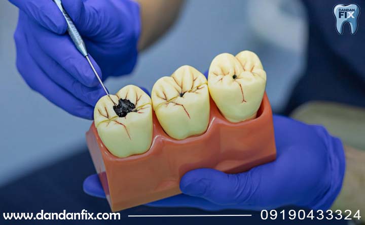 عصب کشی دندان پوسیده