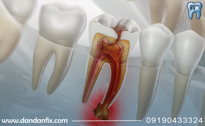 پیشگیری از آبسه دندان