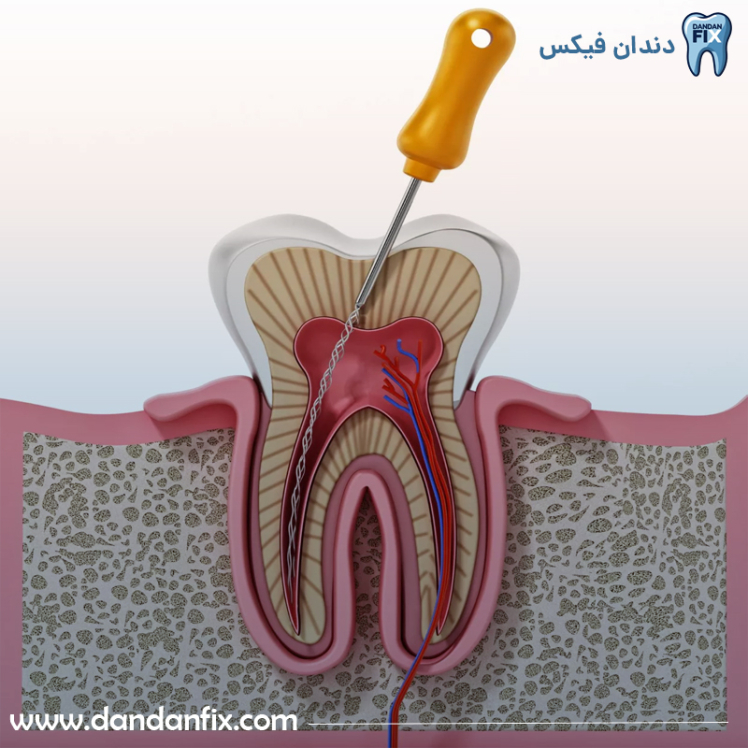 عصب کشی دندان چه زمانی لازم است و چگونه انجام میشود؟