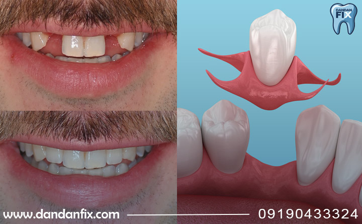 فلیپر چقدر دوام دارد؟