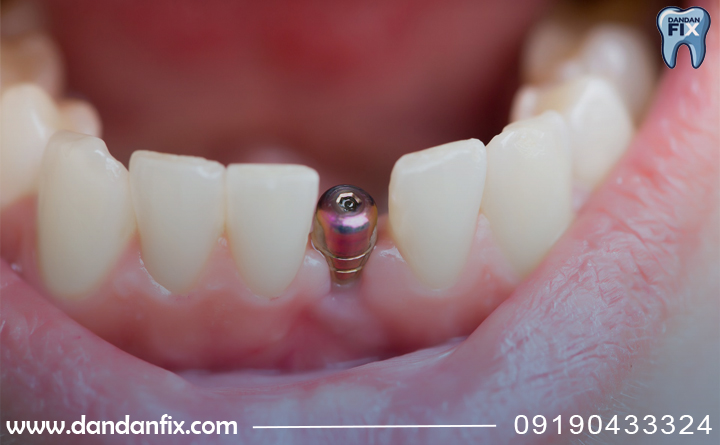 کاشت ایمپلنت تک دندان