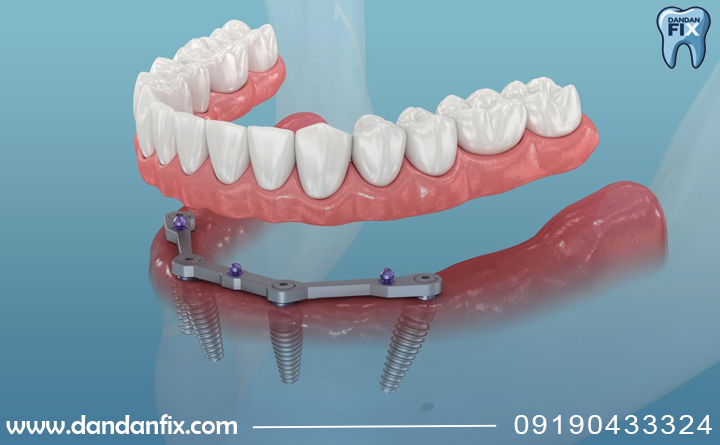 دندان مصنوعی کامل