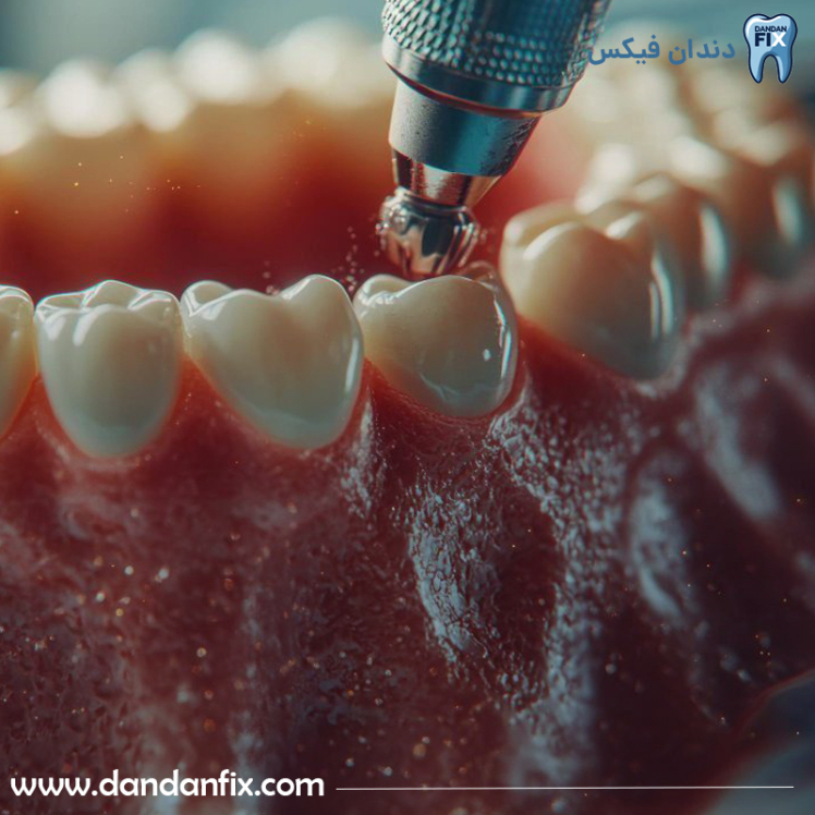 جرم گیری ایمپلنت دندان - ایمپلنت را میتوان جرم گیری کرد؟