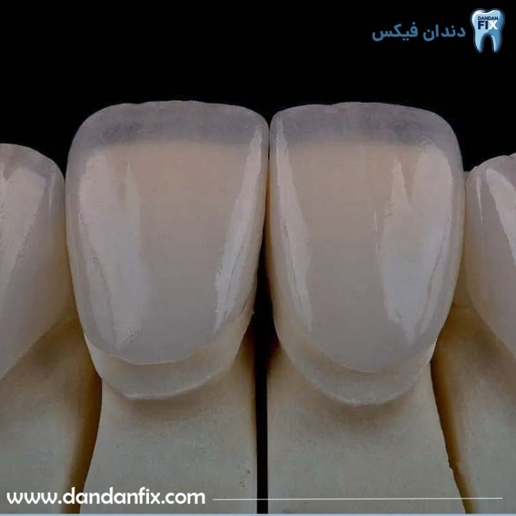 لمینت دندان چیست؟ انواع لمینت و مراحل انجام آن