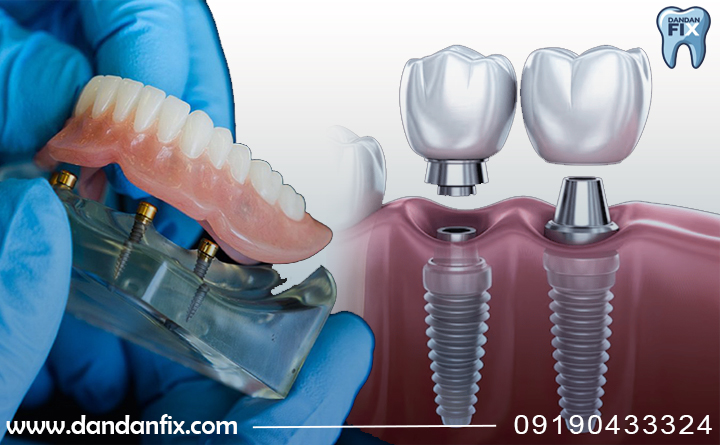 فرق بین ایمپلنت و دندان مصنوعی ثابت
