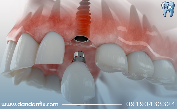تفاوت های اصلی ایمپلنت و دندان مصنوعی ثابت