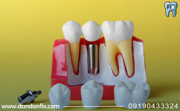 ایمپلنت دندان