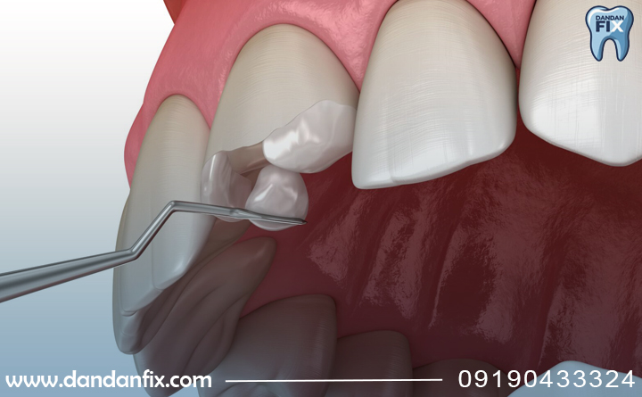 زیبایی دندان مصنوعی