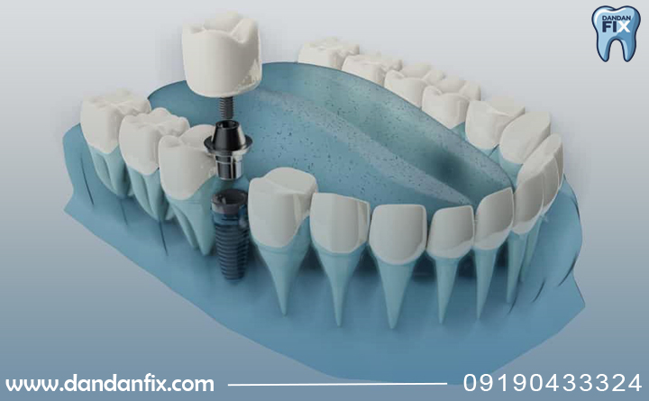 مزایای ایمپلنت دیجیتال