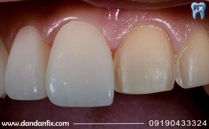 انواع لمینت دندان