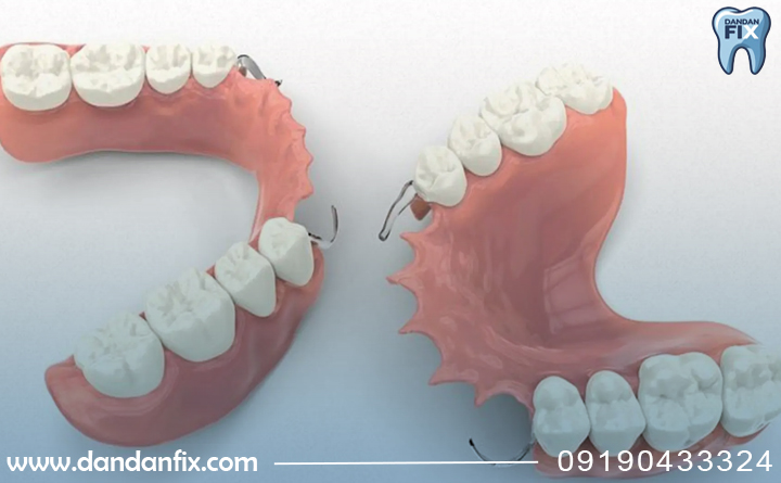 دندان مصنوعی پارسیل چیست؟