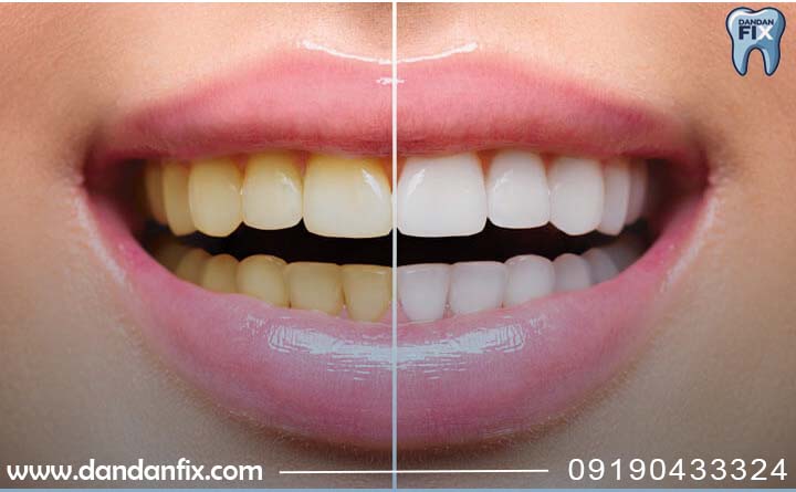 علت زرد شدن دندان ها