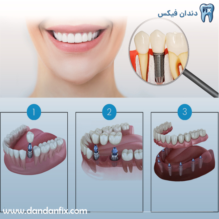 معرفی انواع دندان مصنوعی و تفاوت آنها