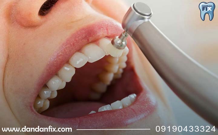 جرمگیری دندان