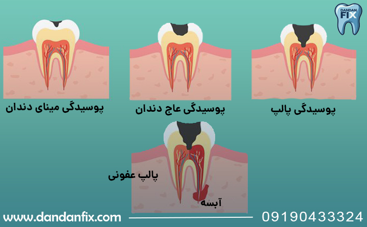 علائم آبسه دندان
