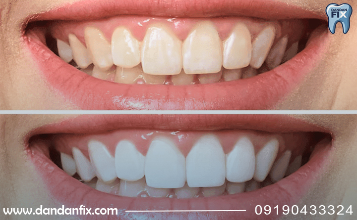 زرد شدن دندان