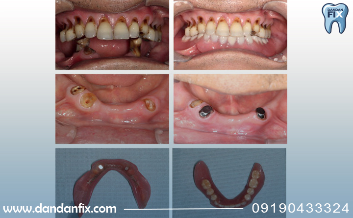 مراحل اوردنچر