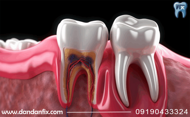 چرا دندان نیاز به عصب کشی نیاز دارد؟