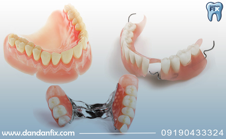 انواع پروتز متحرک