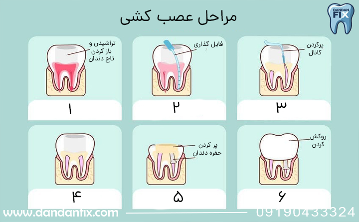 مراحل عصب کشی