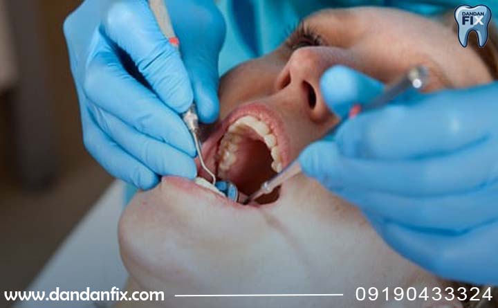  درمان پوسیدگی دندان