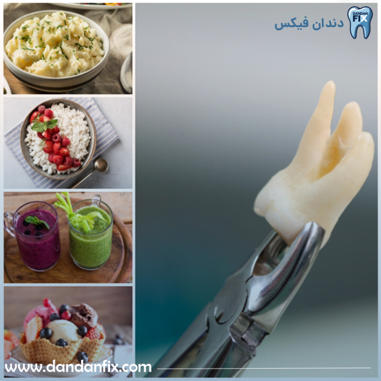 بعد از جراحی دندان عقل چی بخوریم؟معرفی 12 غذای مفید