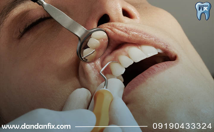 مراحل انجام کامپوزیت