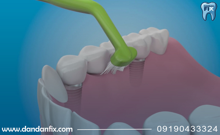 مسواک بعد از ایمپلنت