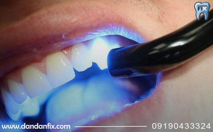 ترمیم یا تعویض کامپوزیت