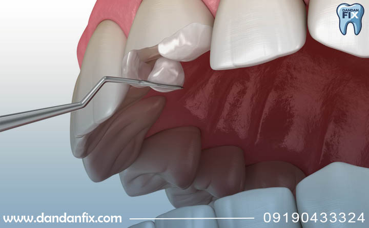 ترمیم لب پریدگی ها