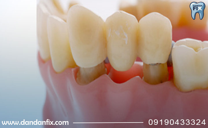 انواع بریج دندان