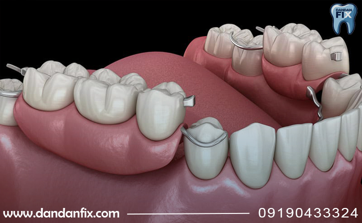 استفاده از پارسیل