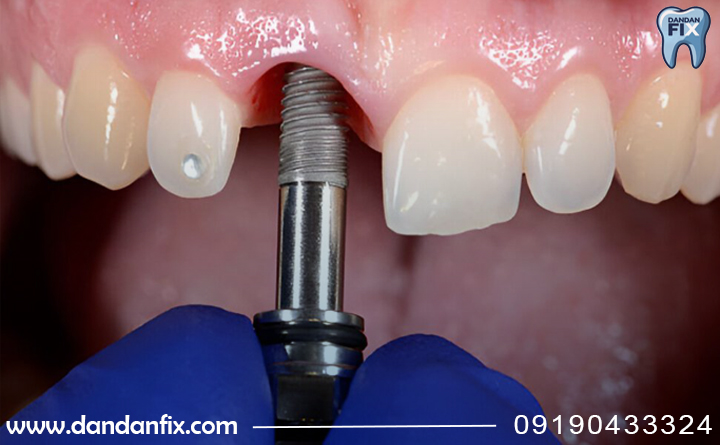 مراحل کاشت ایمپلنت یک دندانی