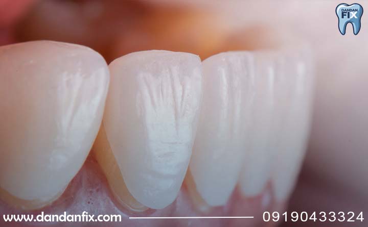 اصلاح فرم با لمینت دندان