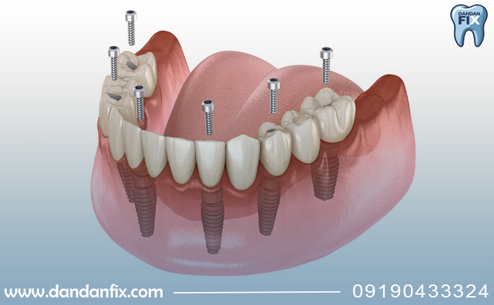 پروتز ثابت بهتره یا ایمپلنت؟