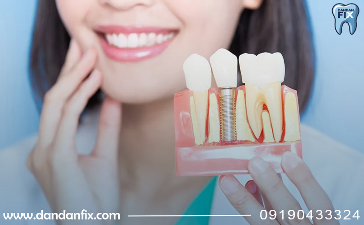 چرا ایمپلنت لق میشود؟