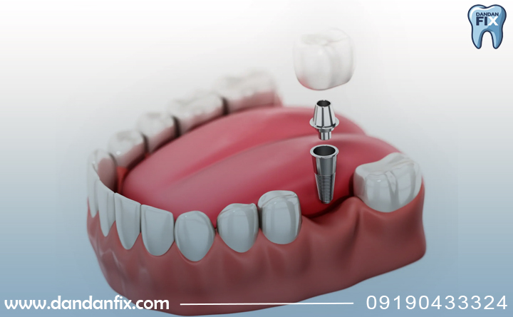 ایمپلنت دندان چیست؟