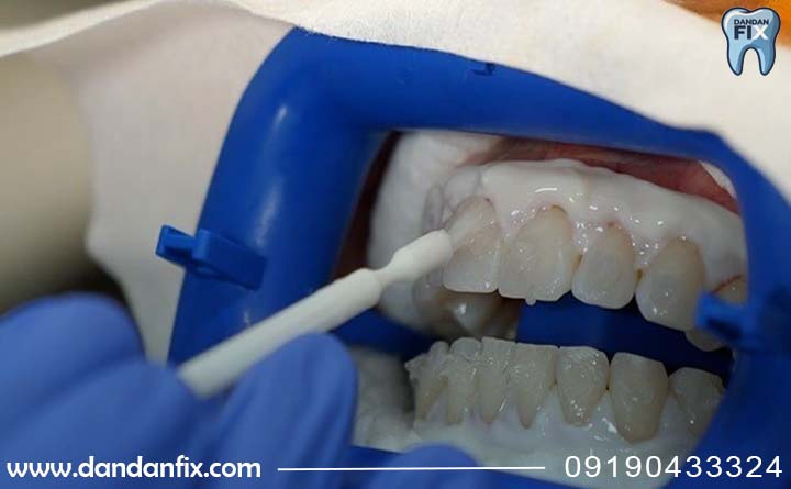 سفید کردن دندان