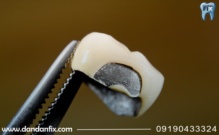 درمان ایمپلنت شکسته در دندان فیکس