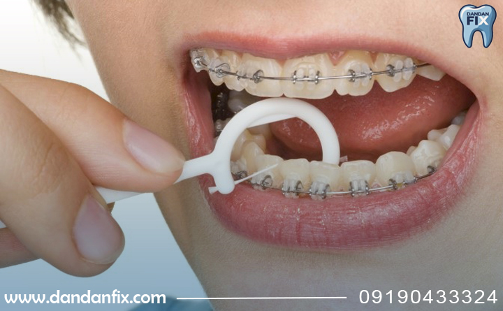 نخ دندان برای افراد ارتودنسی