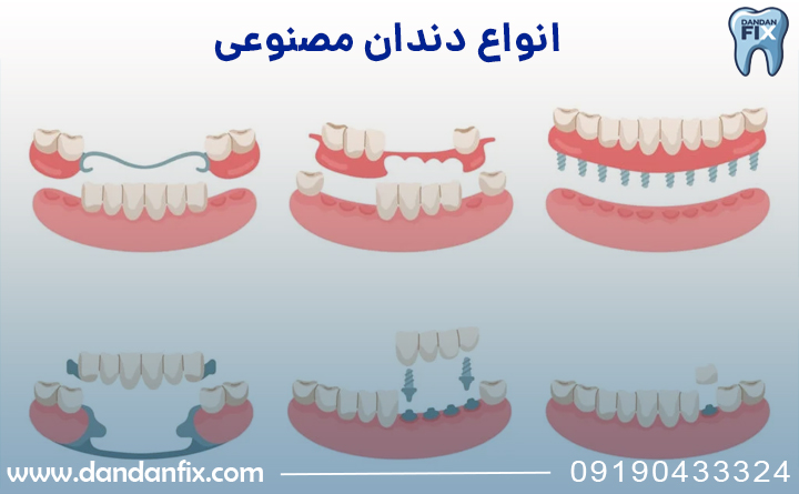 آشنایی با انواع دندان مصنوعی