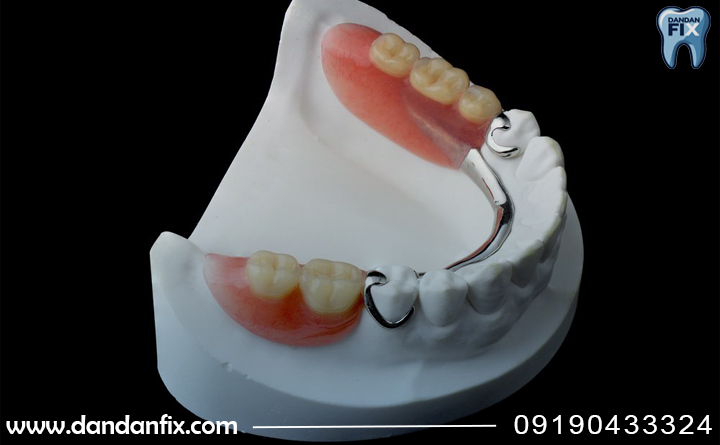 پروتز پارسیل