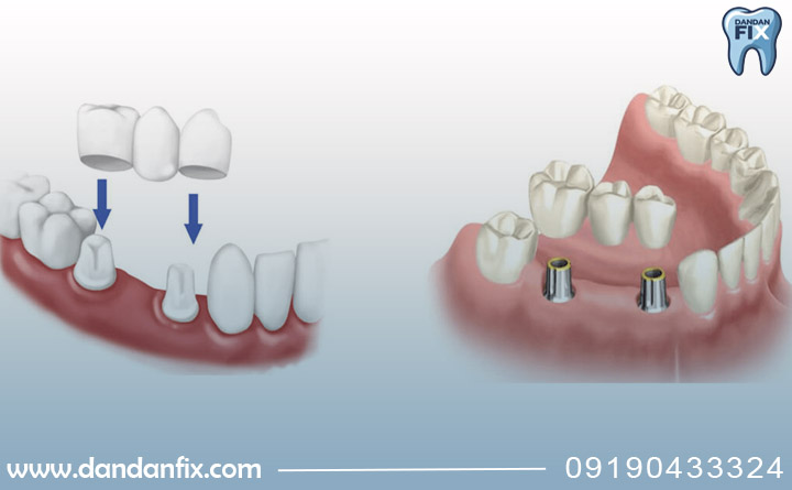 مقایسه ایمپلنت با بریج